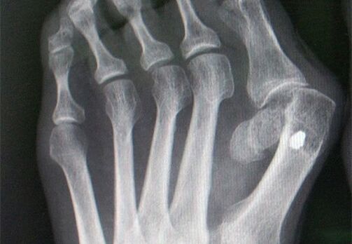 X-RAY