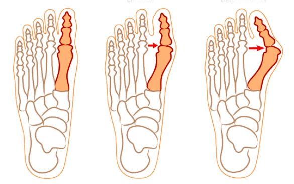 Déformation de l'hallux valgus