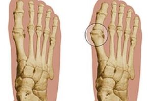 causes de l'hallux valgus