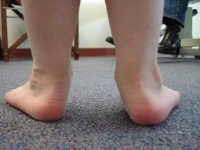 Déformation du pied plat en valgus chez un enfant