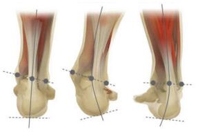 Pied normal, avec déviation en valgus et varus du calcanéum