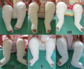 Procédures de plâtrage, chacune modifiant la position du pied
