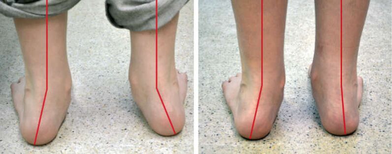 Jambes valgus