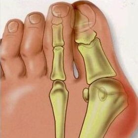 Les raisons de Valgus