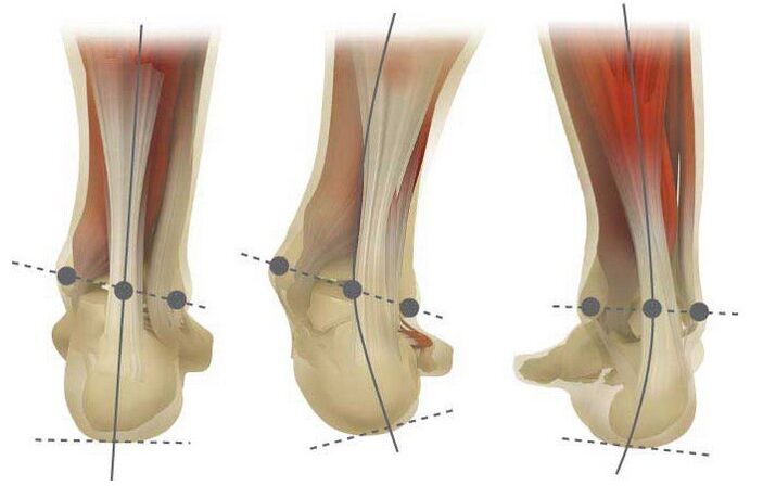 Types de valgus