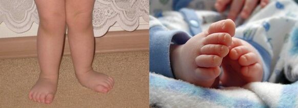 Déformation valgus du pied