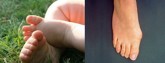 Déformation valgus du premier doigt du pied