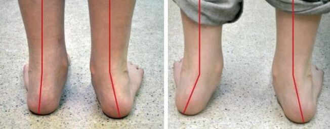 Pied valgus