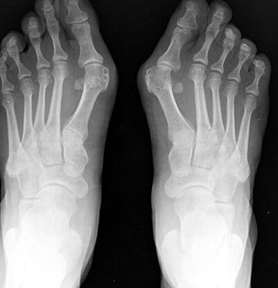 X-rayon du pied